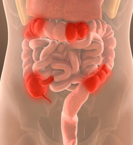 crohn's disease